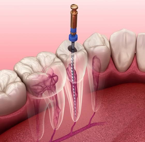 Root Canal Treatment