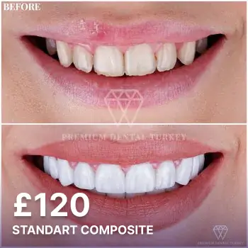 Standart Composite Veneers W?th Pricing