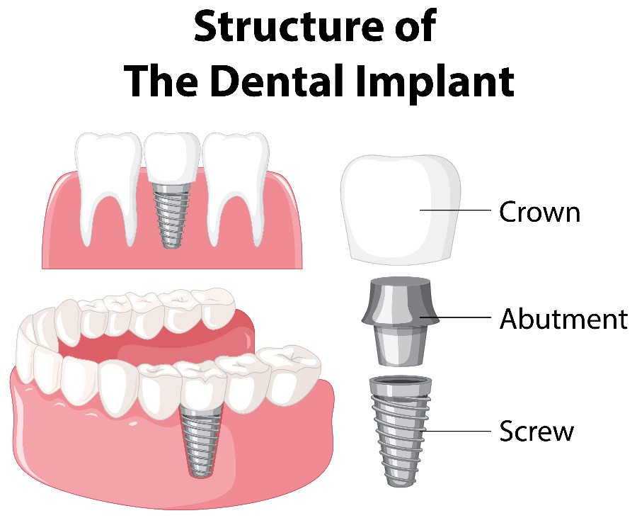 Structure of dental implant
