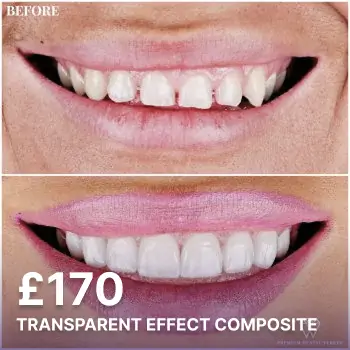 Transparent Effect Composite Veneers W?th Pricing