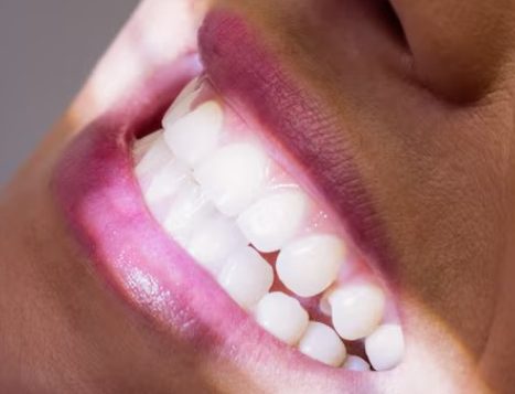 Zirconium Veneers in Turkey