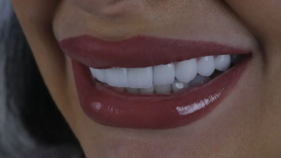 e-max veneers